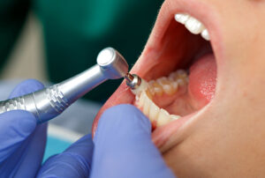 歯周病予防